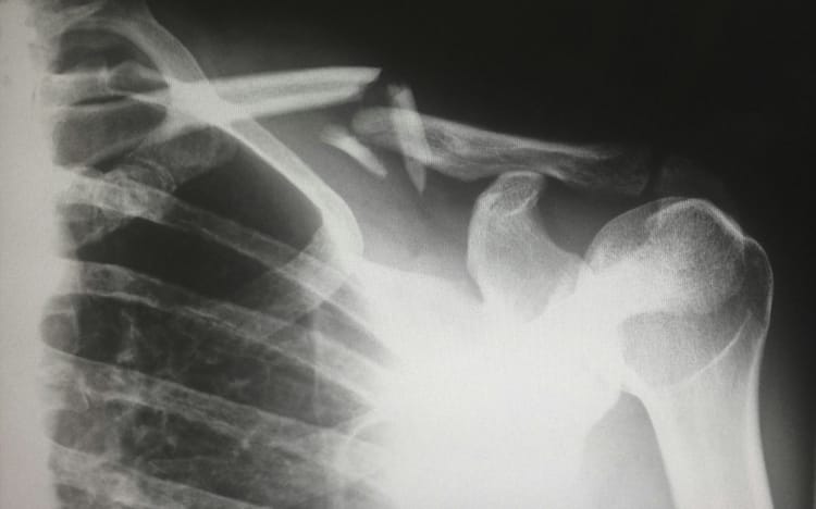 Section B: Rehab after fracture